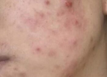 Nguy cơ ung thư da, lão hóa da từ việc sử dụng mỹ phẩm không rõ nguồn gốc trên mạng