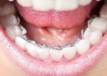 Phương pháp niềng răng nào tối ưu nhất?