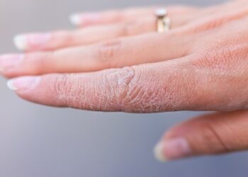 12 thực phẩm bảo vệ và dưỡng ẩm cho da khô khi chuyển mùa