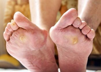 7 mẹo chăm sóc da người bệnh đái tháo đường cần biết