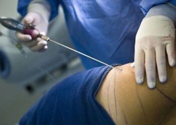 ‘Tiền mất tật mang’ vì hút mỡ bụng tại cơ sở không an toàn