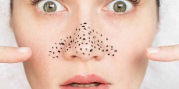 Xử lý thế nào khi lỗ chân lông to?