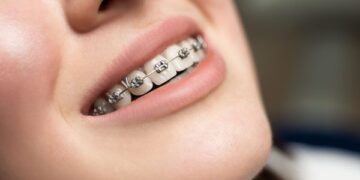 11 quan niệm sai lầm về niềng răng