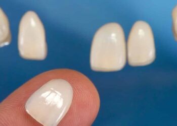 8 nhược điểm của dán sứ veneer và cách khắc phục