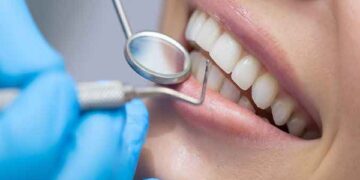 Lưu ý trước và sau khi dán sứ veneer