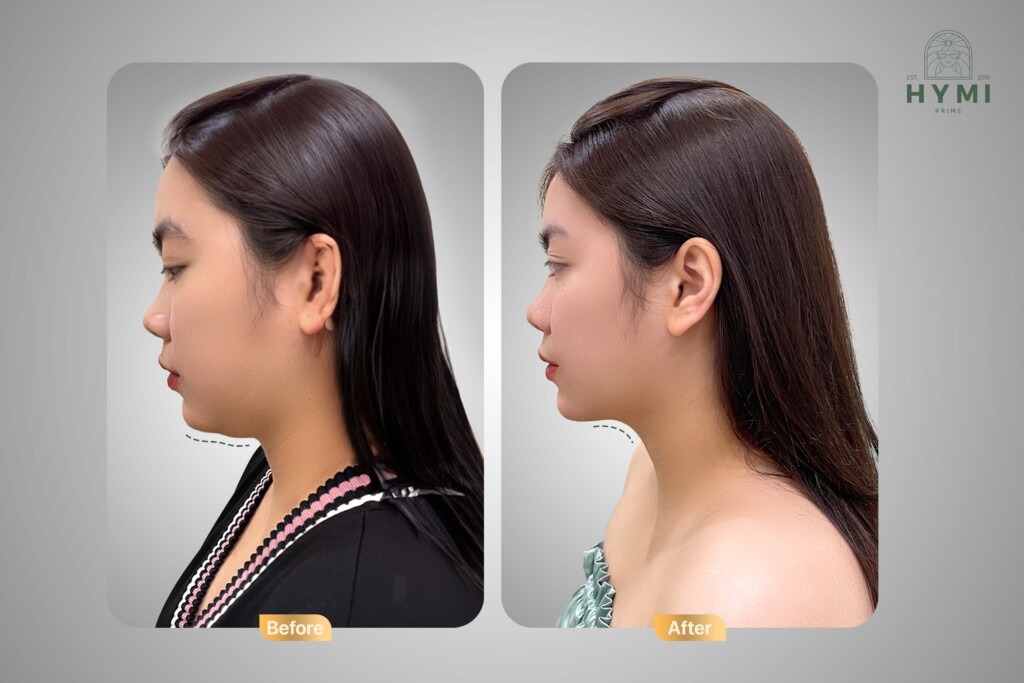 Giảm mỡ AN TOÀN - HIỆU QUẢ - Đâu là phương pháp hoàn hảo dành cho bạn? 2 giam mo an toan hieu qua dau la phuong phap hoan hao danh cho ban 1