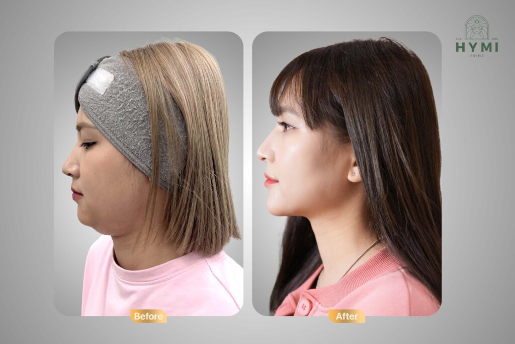 Giảm mỡ AN TOÀN - HIỆU QUẢ - Đâu là phương pháp hoàn hảo dành cho bạn? 3 giam mo an toan hieu qua dau la phuong phap hoan hao danh cho ban 2