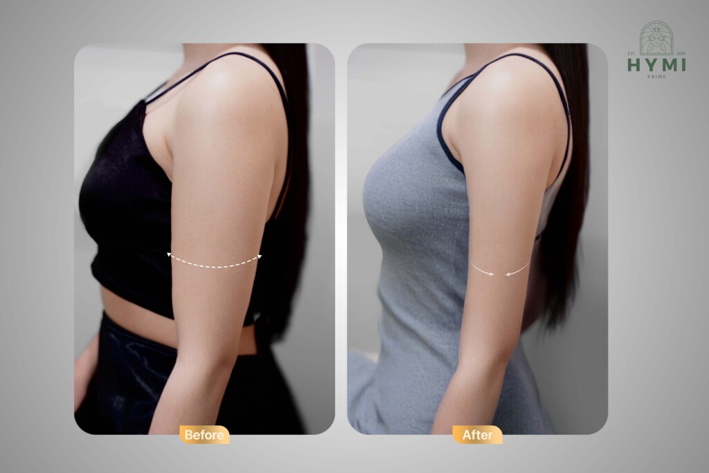 Giảm mỡ AN TOÀN - HIỆU QUẢ - Đâu là phương pháp hoàn hảo dành cho bạn? 4 giam mo an toan hieu qua dau la phuong phap hoan hao danh cho ban 3