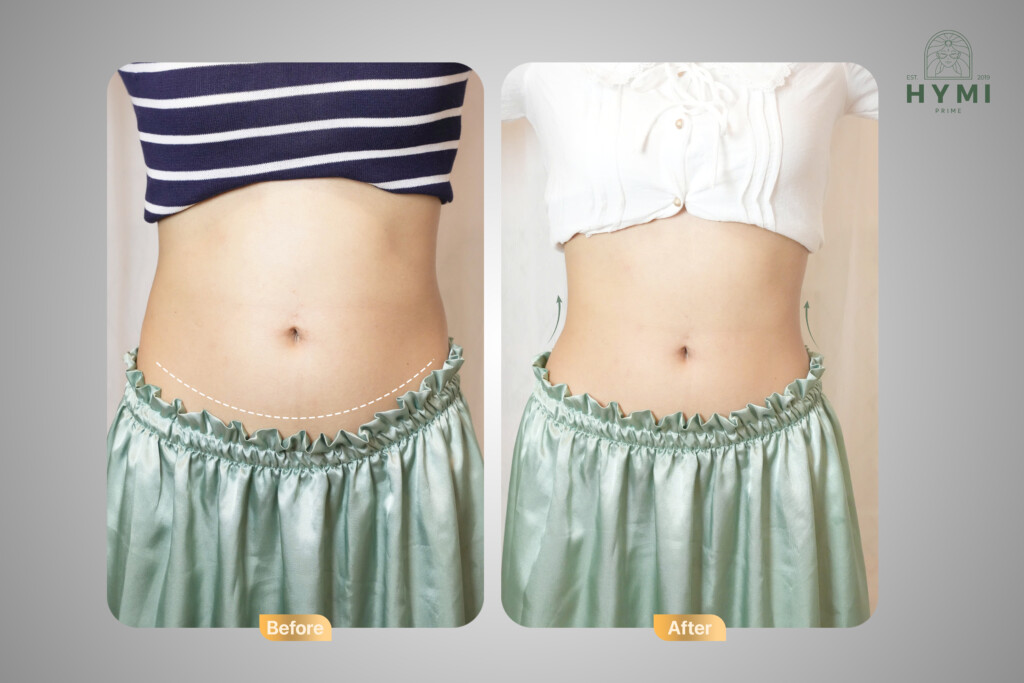 Giảm mỡ AN TOÀN - HIỆU QUẢ - Đâu là phương pháp hoàn hảo dành cho bạn? 5 giam mo an toan hieu qua dau la phuong phap hoan hao danh cho ban 4