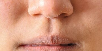 Dưỡng ẩm cho da khi mùa hanh khô